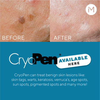 NEW Cryo Pen Treatments - Special offer 50% off  November and December 2025